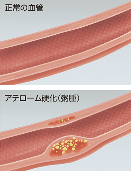 虚血性心疾患