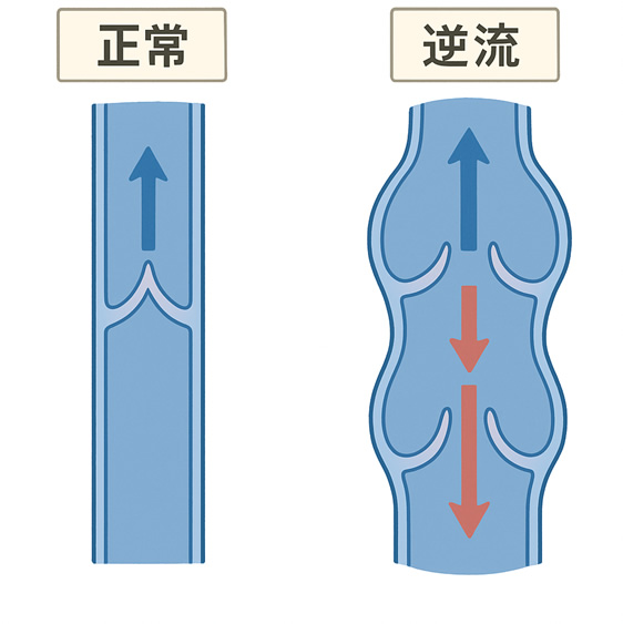下肢静脈瘤
